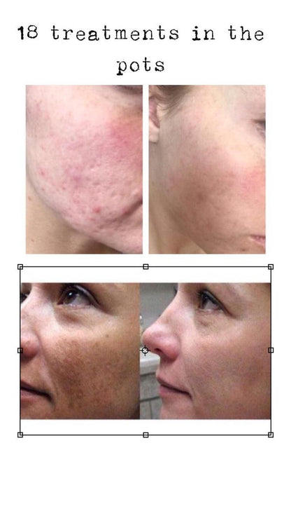 Peeling puissant anti tâche, cicatrices acnés, éclat de peau